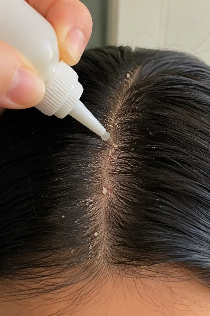 Dry Scalp in Winter Shows Up in Your Fringe First